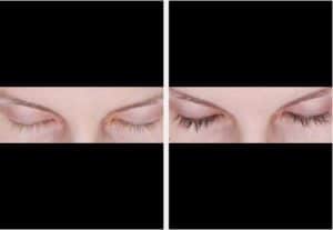 Before & After Latisse Anaheim Hills CA