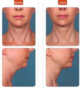 Kybella Before & After Photos
