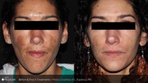 PicoSure Laser Treatment Before & After Photo