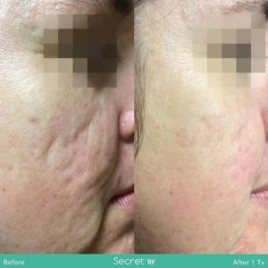 Before & After Photo of Secret RF Huntington Beach