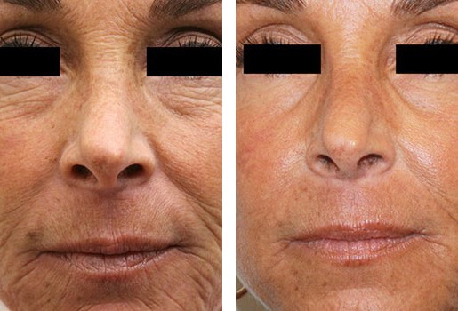 C02 laser resurfacing before and after