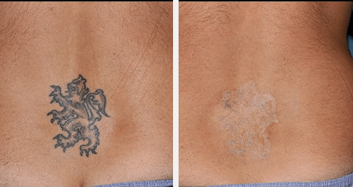 Ankle Wave Tattoo Removed with 3 Sessions of PiQo4 Laser Tattoo Removal for  Asian American Woman Before  After Photos New Jersey  Reflections Center