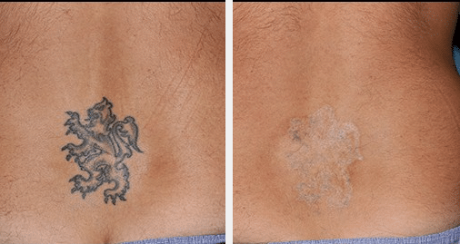 The Power of Before  Afters Feat InkAway Laser Tattoo Removal